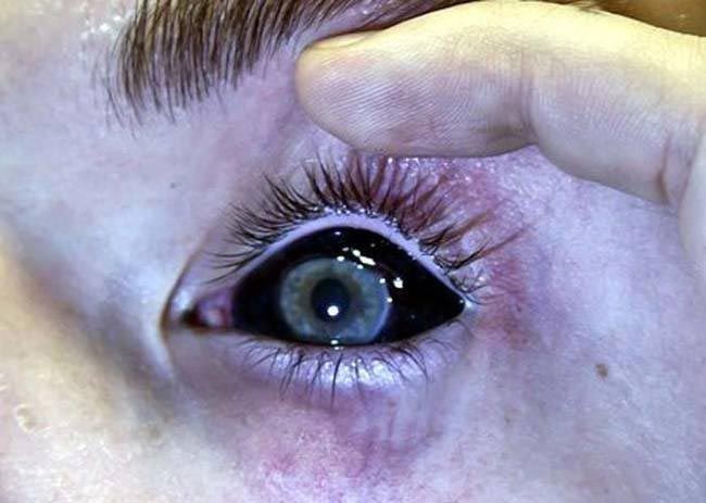 Татуированные глазные яблоки-3