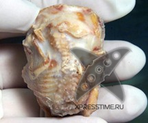 У 80-летней колумбийки в животе нашли 40-летнего эмбриона