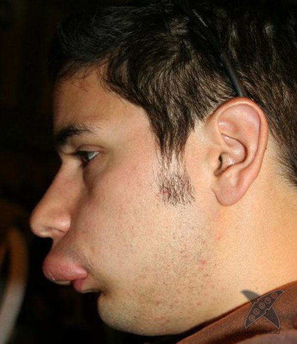 Последствия укуса пчелы