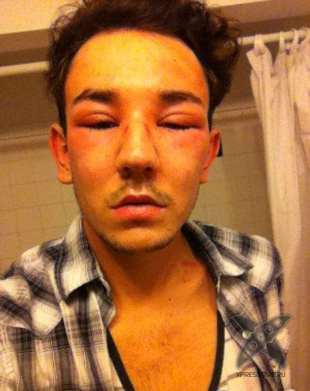 Последствия укуса пчелы