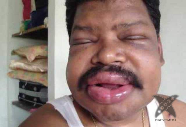 Последствия укуса пчелы