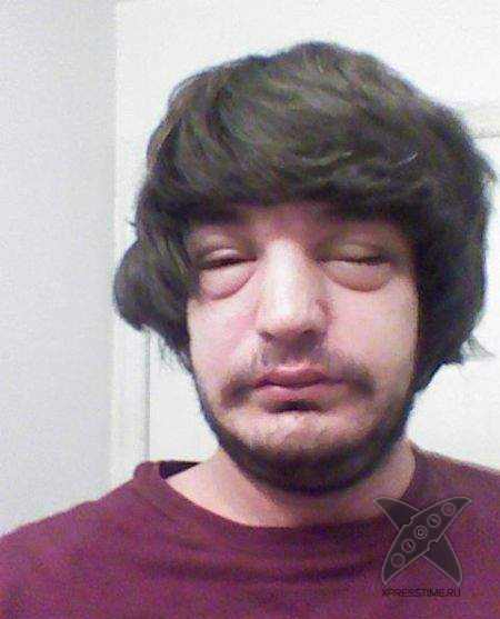 Последствия укуса пчелы