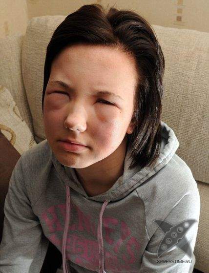 Последствия укуса пчелы