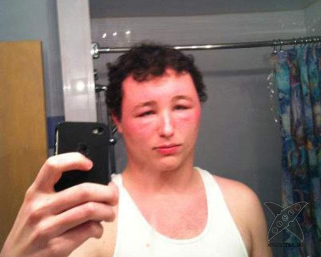 Последствия укуса пчелы