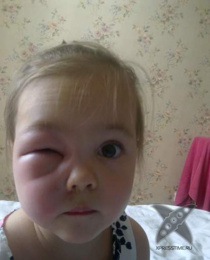 Последствия укуса пчелы