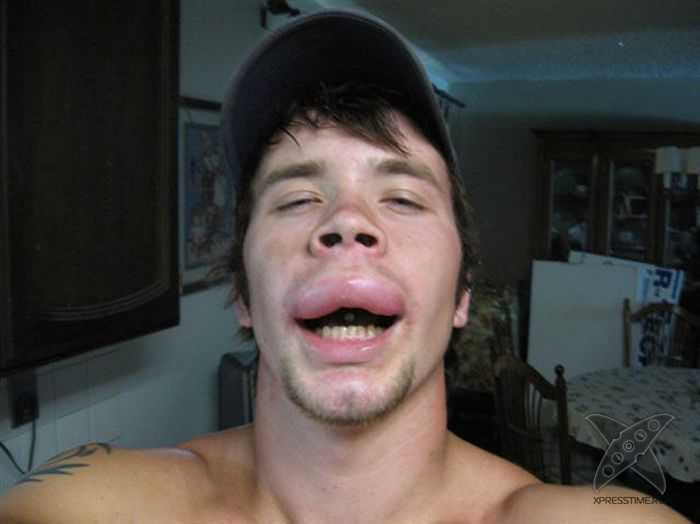 Последствия укуса пчелы