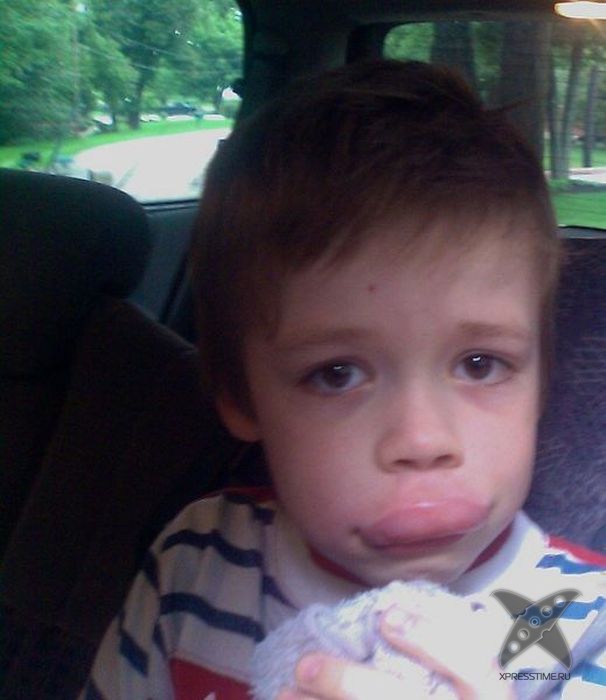 Последствия укуса пчелы