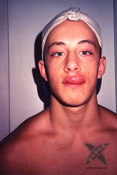 Последствия укуса пчелы