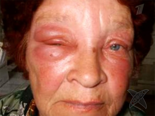 Последствия укуса пчелы