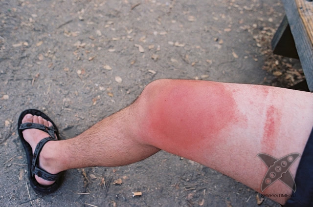 Последствия укуса пчелы