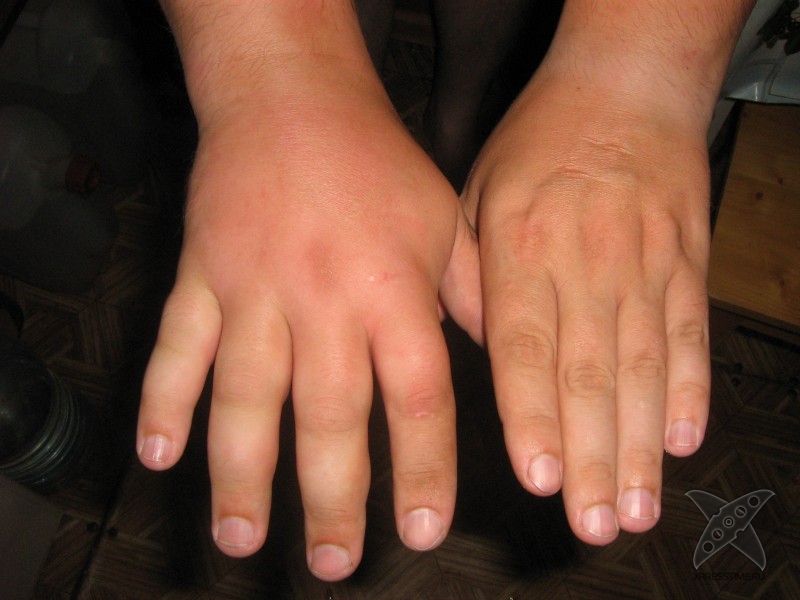 Последствия укуса пчелы