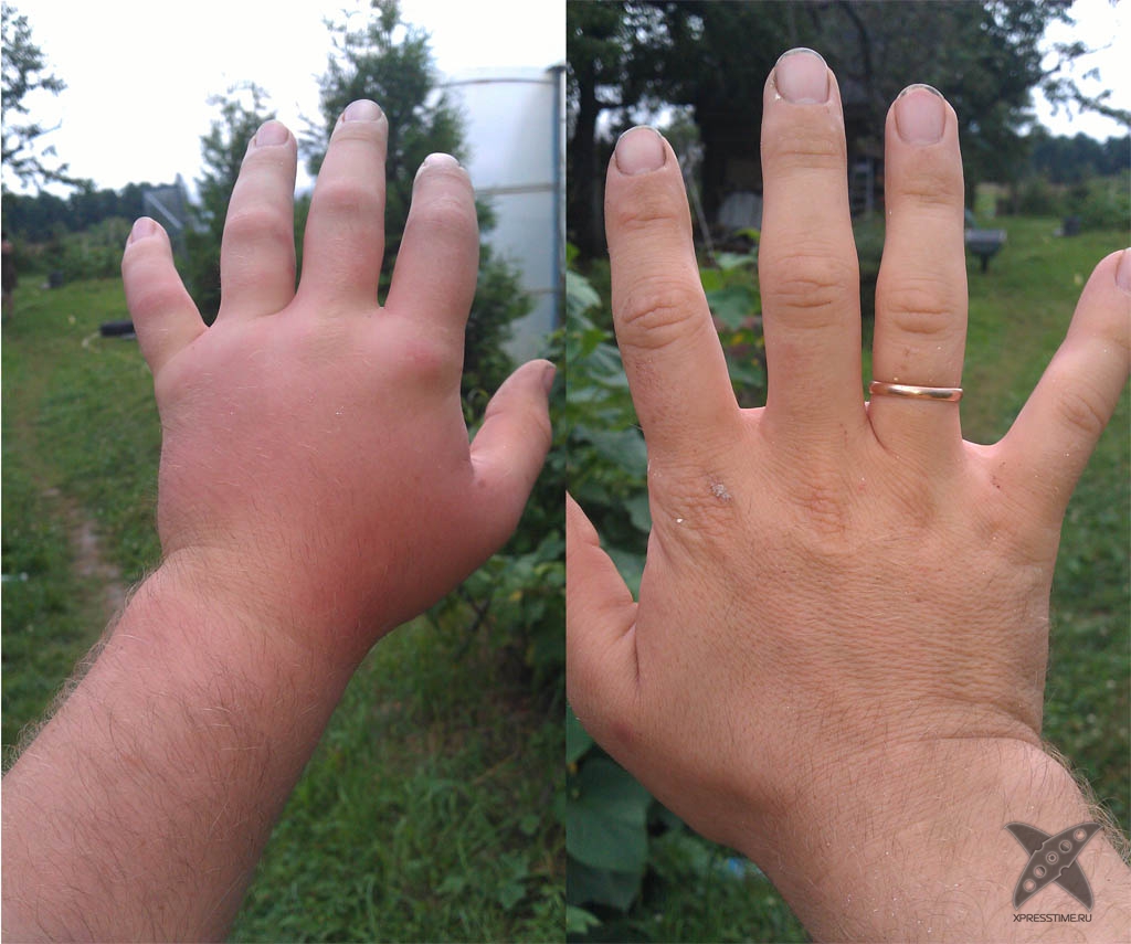 Последствия укуса пчелы