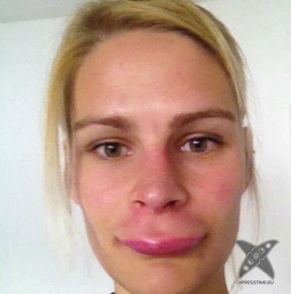 Последствия укуса пчелы