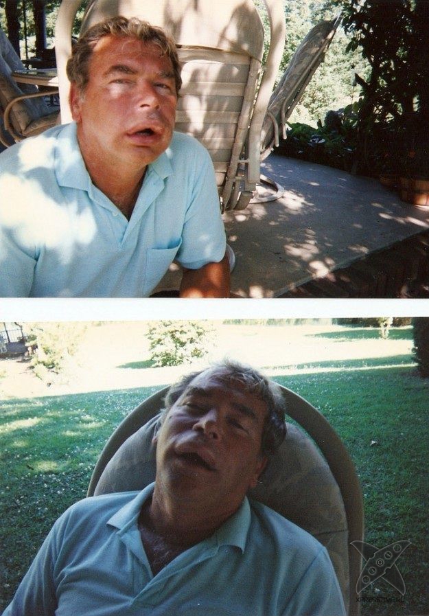 Последствия укуса пчелы