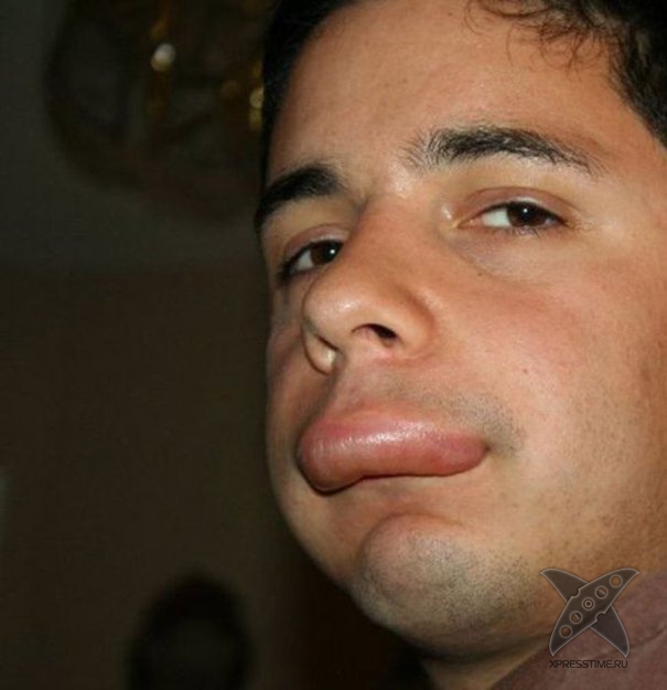 Последствия укуса пчелы