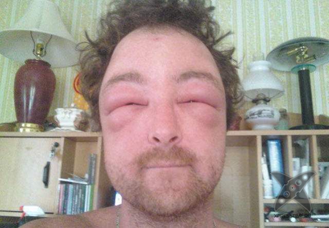 Последствия укуса пчелы