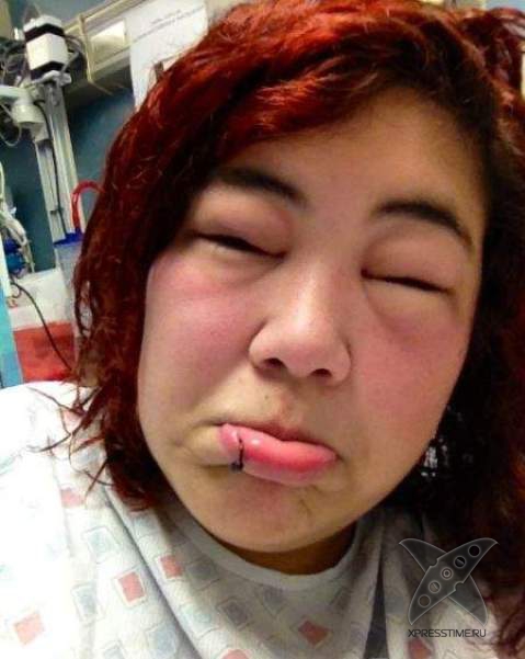 Последствия укуса пчелы