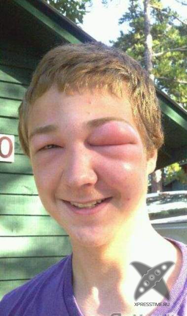 Последствия укуса пчелы