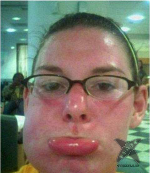 Последствия укуса пчелы