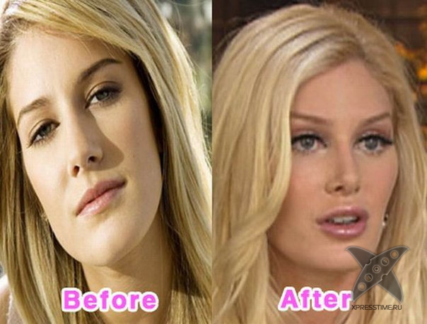 Неудачные последствия пластической хирургии