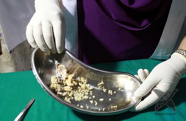 Во рту индийского подростка обнаружили 232 зуба