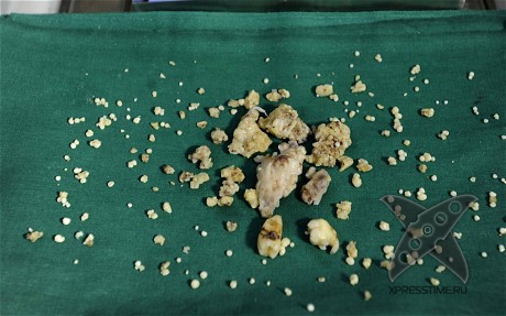 Во рту индийского подростка обнаружили 232 зуба