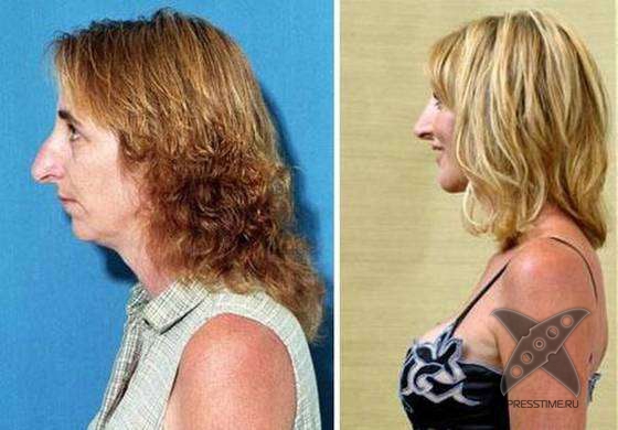 Чудеса пластики и косметики