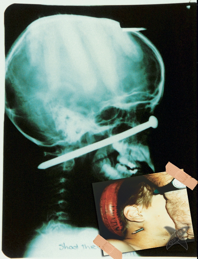 Странные предметы из тел пациентов