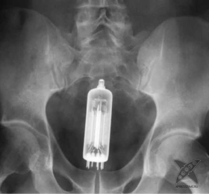 Странные предметы из тел пациентов