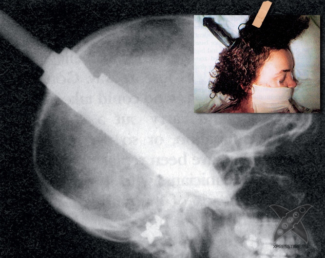 Странные предметы из тел пациентов