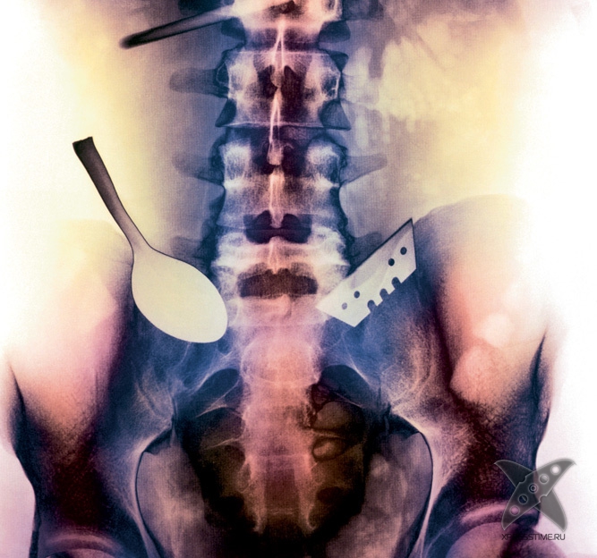 Странные предметы из тел пациентов