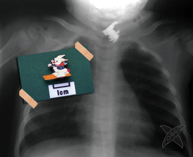 Странные предметы из тел пациентов