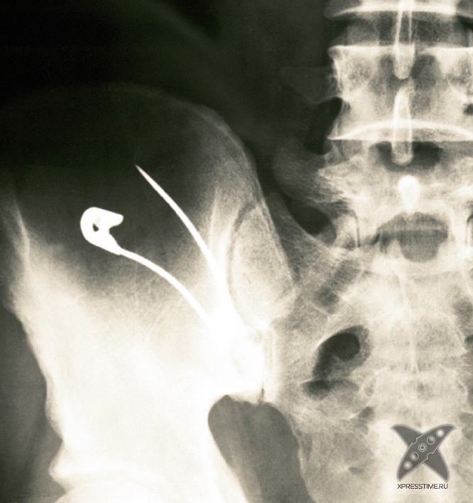 Странные предметы из тел пациентов