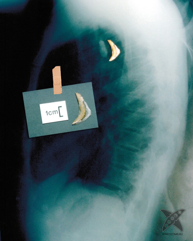 Странные предметы из тел пациентов