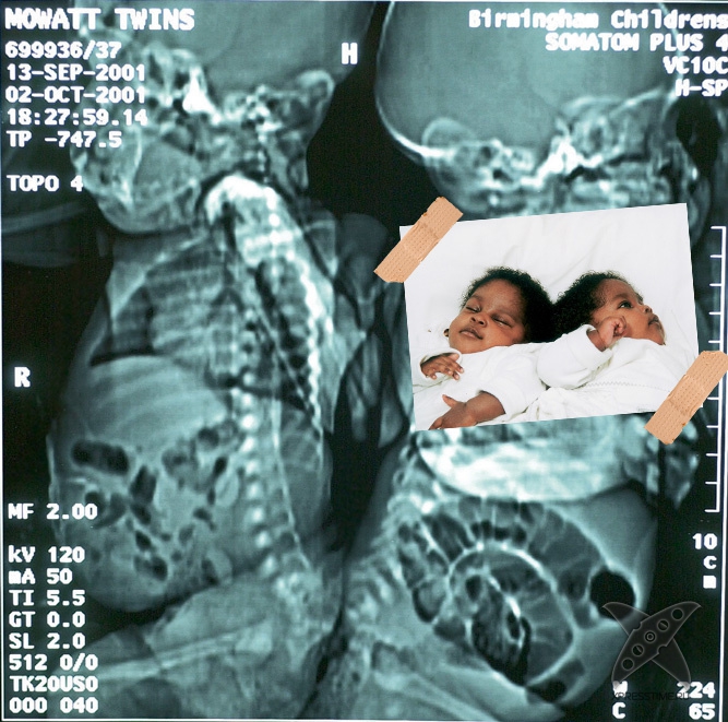 Странные предметы из тел пациентов