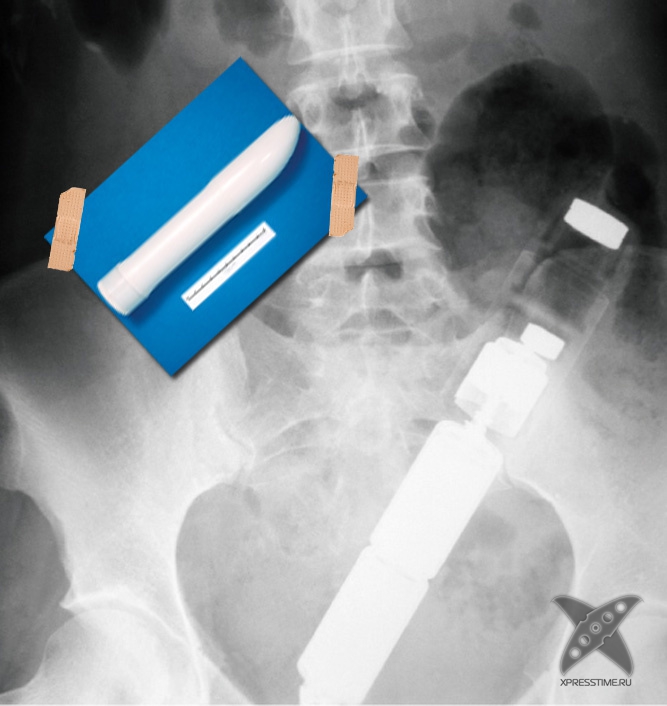 Странные предметы из тел пациентов