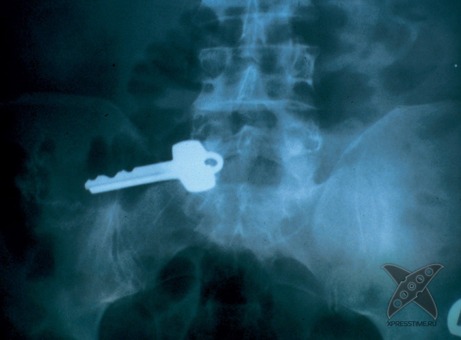 Странные предметы из тел пациентов