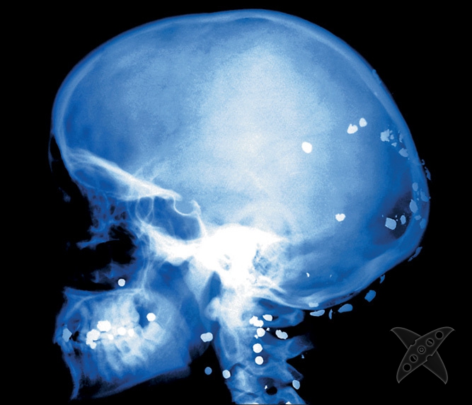 Странные предметы из тел пациентов