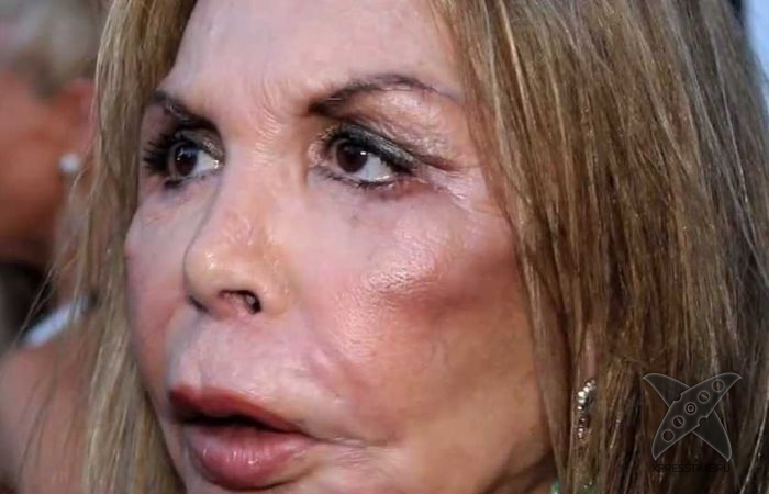 Жертва пластической хирургии Эльза Паттон