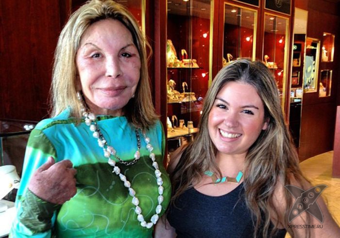 Жертва пластической хирургии Эльза Паттон