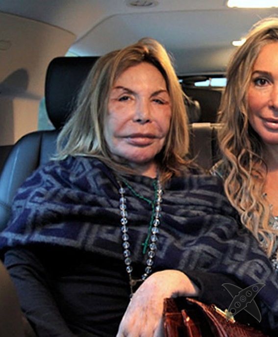 Жертва пластической хирургии Эльза Паттон