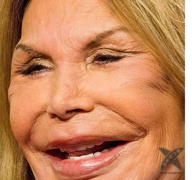 Жертва пластической хирургии Эльза Паттон