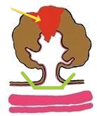 Рак отмечен стрелкой, а зеленым - где отрезали