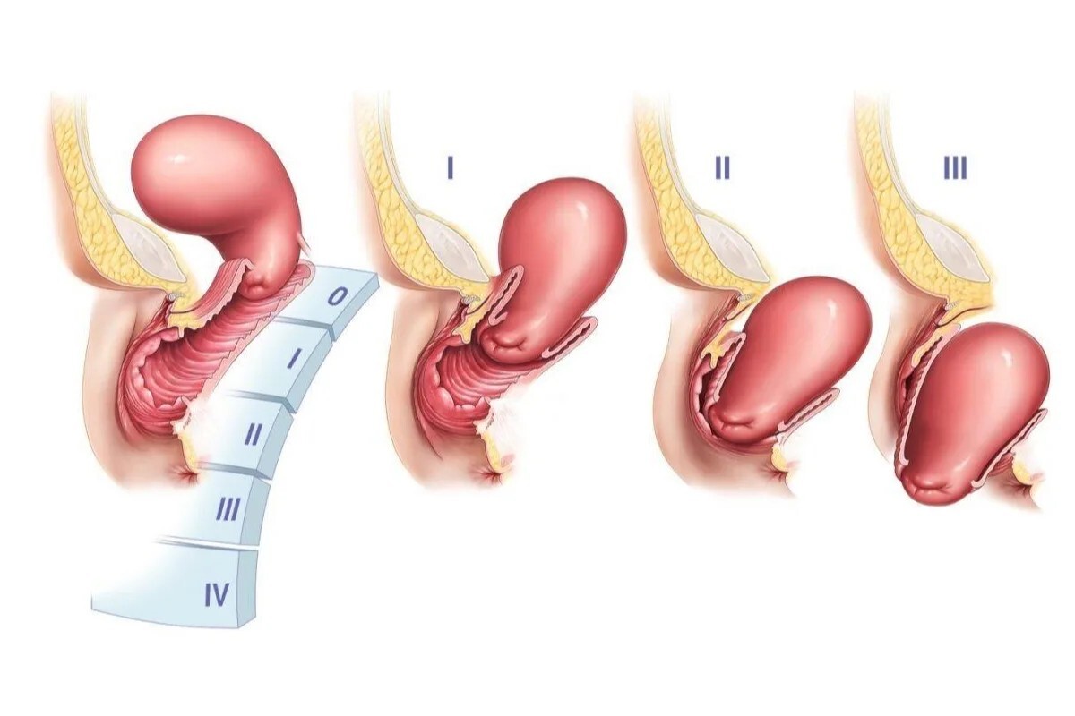 Шкала, докуда могут доехать тазовые органы, если им не мешать.