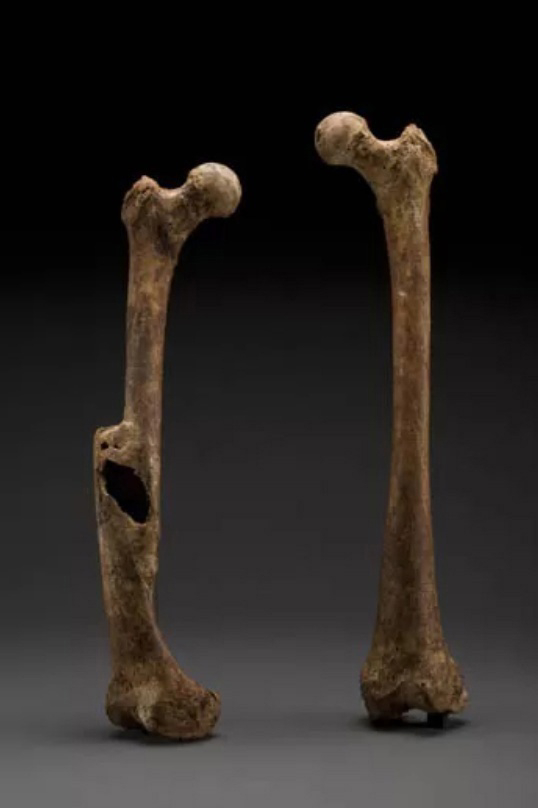 Смещенный, сросшийся перелом правой бедренной кости женщины